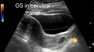 Abortion in progress in early pregnancy ultrasound and color Doppler imaging study [upl. by Esenej]