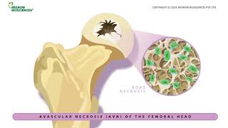 OSSGROW for Avascular Necrosis of Hip Joint [upl. by Elumas]