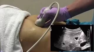 How I do it Ultrasound of the Abdomen [upl. by Steddman997]