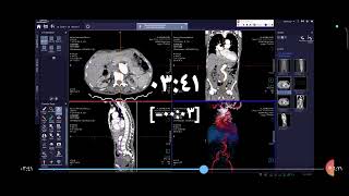 ct aortography ct siemens go now [upl. by Airekahs]