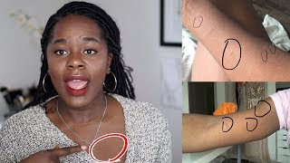 My Skin Story  How I got rid of Pityriasis Rosea  TheAdeTomi [upl. by Jovitah]