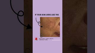 Treat your dryness melasma amp uneven skintone within a week brightskin skininfluencer skinfirst [upl. by Faubion597]