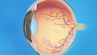 Torn Retina Photocoagulation [upl. by Eelsel964]