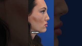 Filler Dissolving and Midface rejuvenation microneedling fattransfer fillerdissolving morpheus8 [upl. by Salangia]