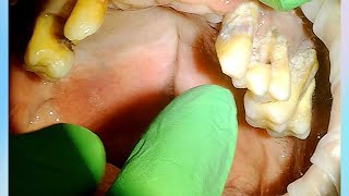 Severe Periodontal Disease Tartar Calculus with Extractions [upl. by Germano375]