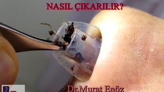 Silikon Burun Tamponu Nasıl Çıkarılır Nasal Splint Removal [upl. by Schreib]