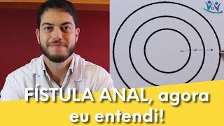 Fístula anal explicada de um jeito fácil de entender  Dr Marcelo Werneck [upl. by Jobie]