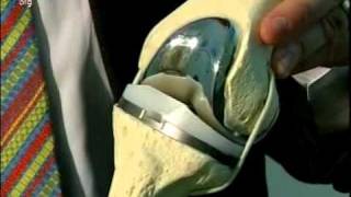 Knee Minimally Invasive Total Knee Replacement Surgery Part 1 [upl. by Llahsram]