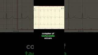 FOCAL ATRIAL TACHYCARDIA ECG EXAMPLE [upl. by Naahs]