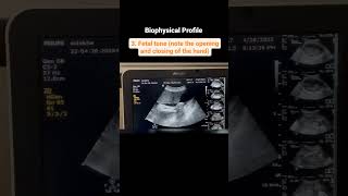 Components of a Biophysical Profile [upl. by Nyleuqcaj]