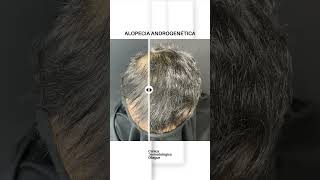 Tratamientos para alopecia androgenética [upl. by Orabla543]