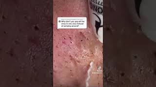 Cystic Acne Removal amp Inflammatory Acne [upl. by Safoelc]