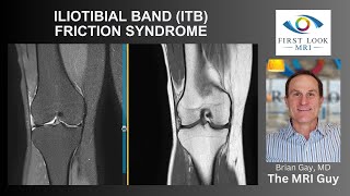 ILIOTIBIAL BAND ITB FRICTION SYNDROME [upl. by Siusan]