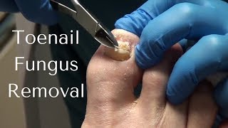 Toenail Fungus Removal  How to Cut Toenail Fungus [upl. by Noreen]