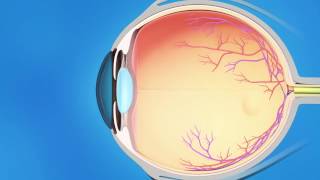 Cyclophotocoagulation CPC for Glaucoma [upl. by Duwalt]