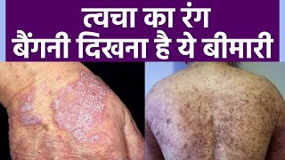 Lichen Planus Skin Disease क्या है  जानें क्या है लाइकेन प्लेनस का Treatment  Boldsky Health [upl. by Quenby]