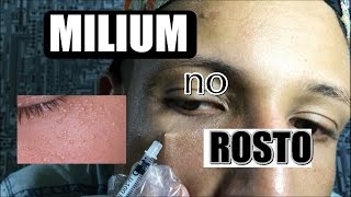 Como eu tiro o MILIUM do meu rosto  Wilianrelaxx [upl. by Luca]