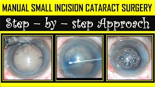 MSICS  Cataract Surgery  Immature Cataract  RIMS Raichur  DrRakesh Koli [upl. by Aiuqes]