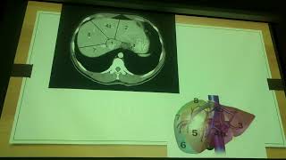 Reseccion Hepática y Pancreática  TECNICAS QUIRURGICAS [upl. by Niawd621]