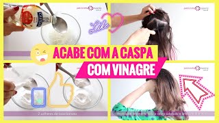 ✅ACABAR com CASPA com VINAGRE TOP⬅】 [upl. by Dnumsed962]