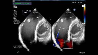 TEE Transgastric View of the Pulmonic valve [upl. by Allenaj736]