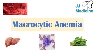 Macrocytic Anemia  Megaloblastic vs NonMegaloblastic  Approach amp Causes [upl. by Jabe]