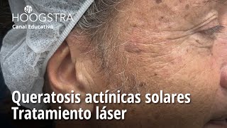 Queratosis actínicas solares  Tratamiento láser  23275 [upl. by Siubhan788]