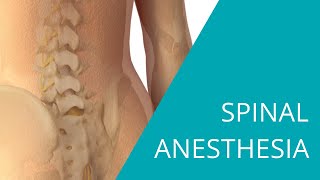 Spinal Anesthesia  The steps of spinal anesthesia [upl. by Fey]