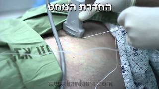 חסם עצבי פמורלי Femoral block [upl. by Giorgi]