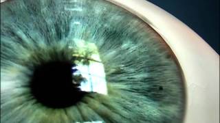 Laser Iridotomy for Angle Closure Glaucoma [upl. by Milstone308]