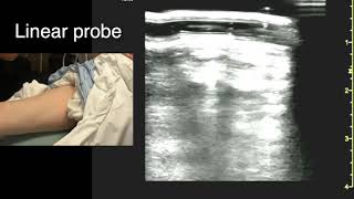 Ultrasound in the Femoral Triangle [upl. by Veronica397]