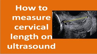 How to Measure Cervical Length by Ultrasound [upl. by Nnylharas]