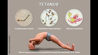 Tetanus  What is Tetanus  Cause symptoms treatment amp prevention of Tetanus [upl. by Nnybor]