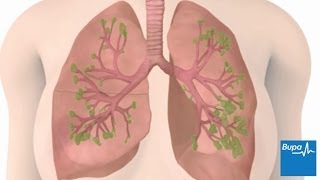 How chronic obstructive pulmonary disease COPD develops  Bupa Health [upl. by Saimon]