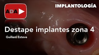 Destape implantes en zona 4 [upl. by Woll392]