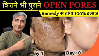 कितने भी पुराने OPEN PORES LARGE PORES CLOGGED PORES इस Remedy से होगा 100 इलाज़ I DR MANOJ DAS [upl. by Asseralc275]