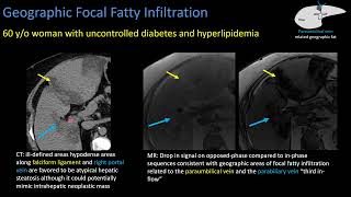 Hepatic Steatosis Part 2 Patterns of Steatosis [upl. by Acemaj]