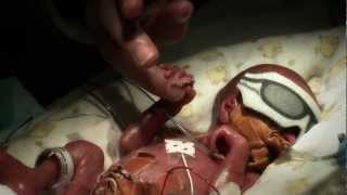 24 week premature baby  Tobys journey [upl. by Arbed]