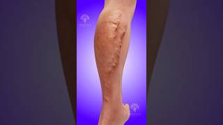 How Varicose Veins Develop 😱 shorts viralvideo  creativelearning3d [upl. by Orteip]