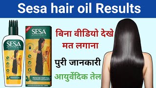 Sesa hair oil results  sesa hair oil kaise use kare  sesa hair oil review  Drx Rabbani [upl. by Enorej995]