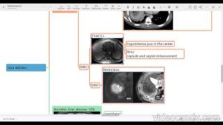 inflammatory liver pathology [upl. by Ecirehs]