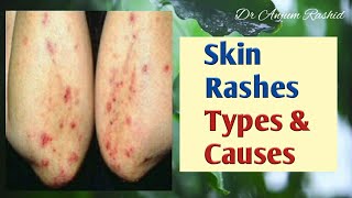 Skin Rashes Types Causes and Identification [upl. by Blaseio966]