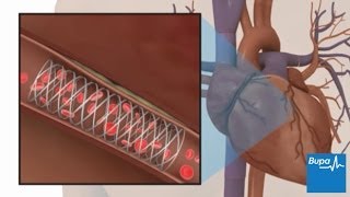 How coronary angioplasty is carried out  Bupa Health [upl. by Willman566]