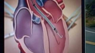 Impella 50 animation showing how it aids heart failure patients [upl. by Akcirred809]