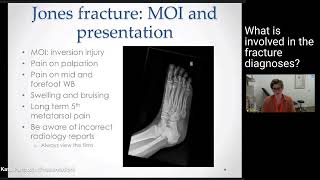 5th Metatarsal Fractures  Treatment amp Diagnosis [upl. by Seiber]