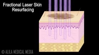 Traditional versus Fractional Laser Skin Resurfacing Procedure Animation [upl. by Hoban]