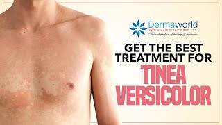 Get The Best Treatment for Tinea Versicolor [upl. by Weiman704]