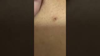 How to remove ingrown hairs [upl. by Chrisy551]