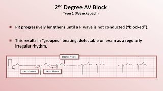 Intro to EKG Interpretation  AV Block [upl. by Placia]