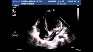 Vegetation of coronary cameral fistula [upl. by Grieve]